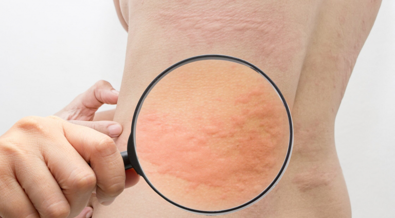 Крапивница: причины возникновения и лечение