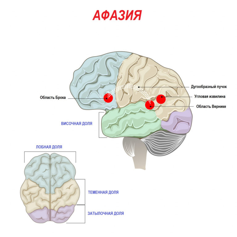 Афазия: расстройство речи и его основные формы