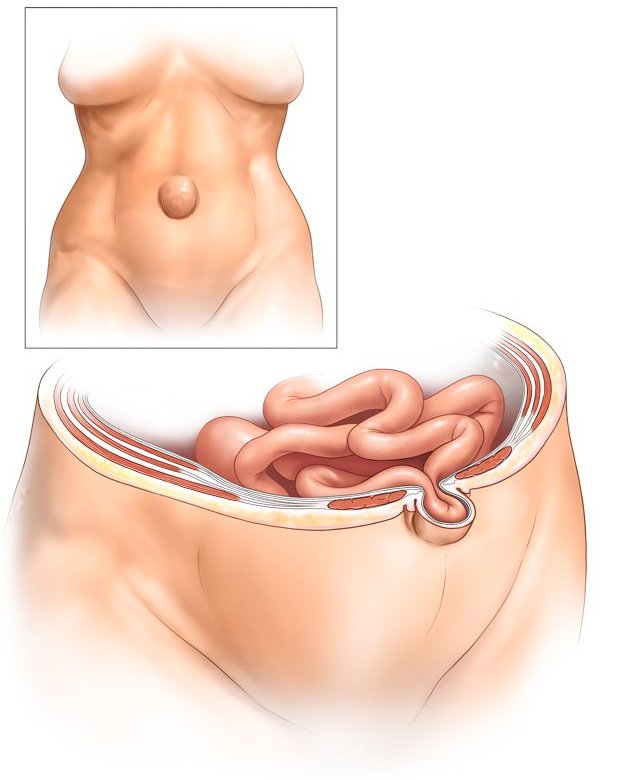 Удаление пупочной грыжи в Екатеринбурге