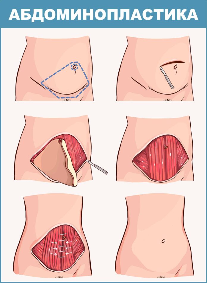 abdominoplastika_i_liposakciya_raznica