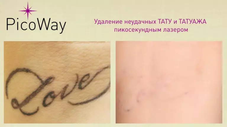 Удаление татуировок пикосекундным лазером